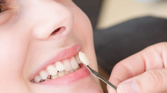 Why Dental Veneers Are Called The Hollywood Makeover